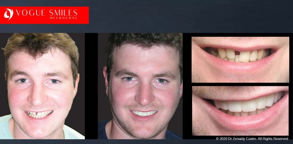 Most Affordable Way To Improve Your Smile in Melbourne CBD and Noble Park North - Snap on Smile Veneers | Removable Smile - Clip on Teeth -Cheapest Cosmetic Dentist in Dandenong North