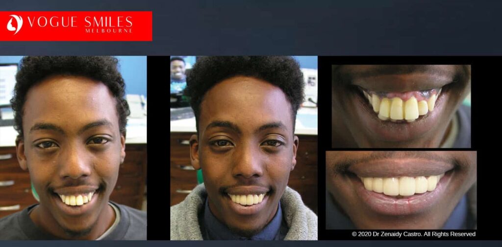 Most Affordable Way To Improve Your Smile in Melbourne CBD and Noble Park North - Snap on Smile Veneers | Removable Smile - Clip on Teeth -Cheapest Cosmetic Dentist in Dandenong North