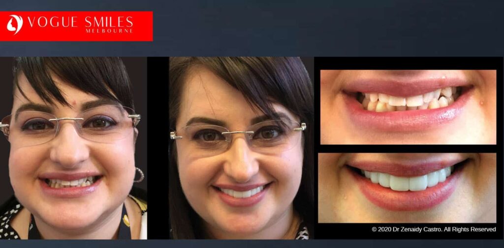 Most Affordable Way To Improve Your Smile in Melbourne CBD and Noble Park North - Snap on Smile Veneers | Removable Smile - Clip on Teeth -Cheapest Cosmetic Dentist in Dandenong North