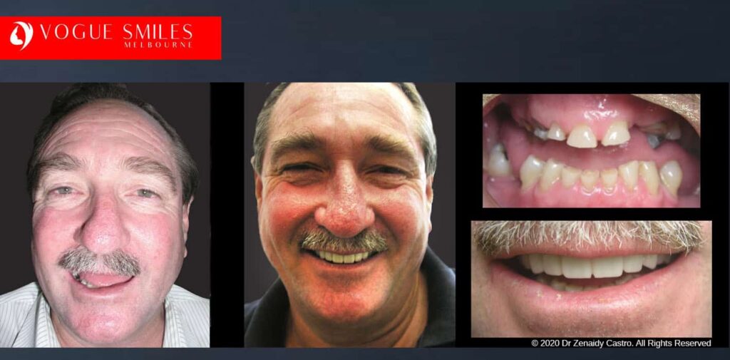 Most Affordable Way To Improve Your Smile in Melbourne CBD and Noble Park North - Snap on Smile Veneers | Removable Smile - Clip on Teeth -Cheapest Cosmetic Dentist in Dandenong North