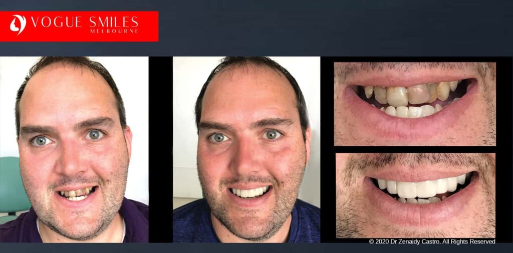 Most Affordable Way To Improve Your Smile in Melbourne CBD and Noble Park North - Snap on Smile Veneers | Removable Smile - Clip on Teeth -Cheapest Cosmetic Dentist in Dandenong North