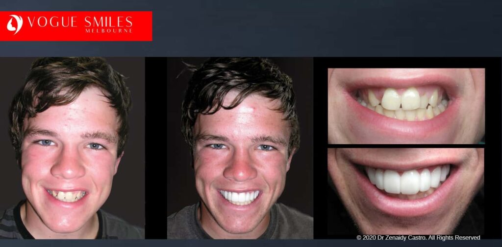 Most Affordable Way To Improve Your Smile in Melbourne CBD and Noble Park North - Snap on Smile Veneers | Removable Smile - Clip on Teeth -Cheapest Cosmetic Dentist in Dandenong North