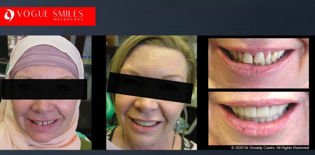 Most Affordable Way To Improve Your Smile in Melbourne CBD and Noble Park North - Snap on Smile Veneers | Removable Smile - Clip on Teeth -Cheapest Cosmetic Dentist in Dandenong North