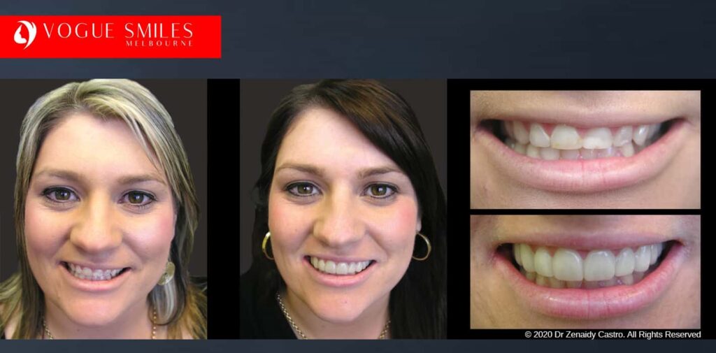 Most Affordable Way To Improve Your Smile in Melbourne CBD and Noble Park North - Snap on Smile Veneers | Removable Smile - Clip on Teeth -Cheapest Cosmetic Dentist in Dandenong North