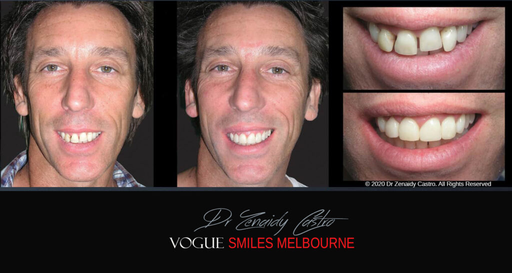 Fix Crooked Teeth - Instant Teeth Straightening with Porcelain Veneers -Family Cosmetic Dental Practice - Noble Park North Dentist
