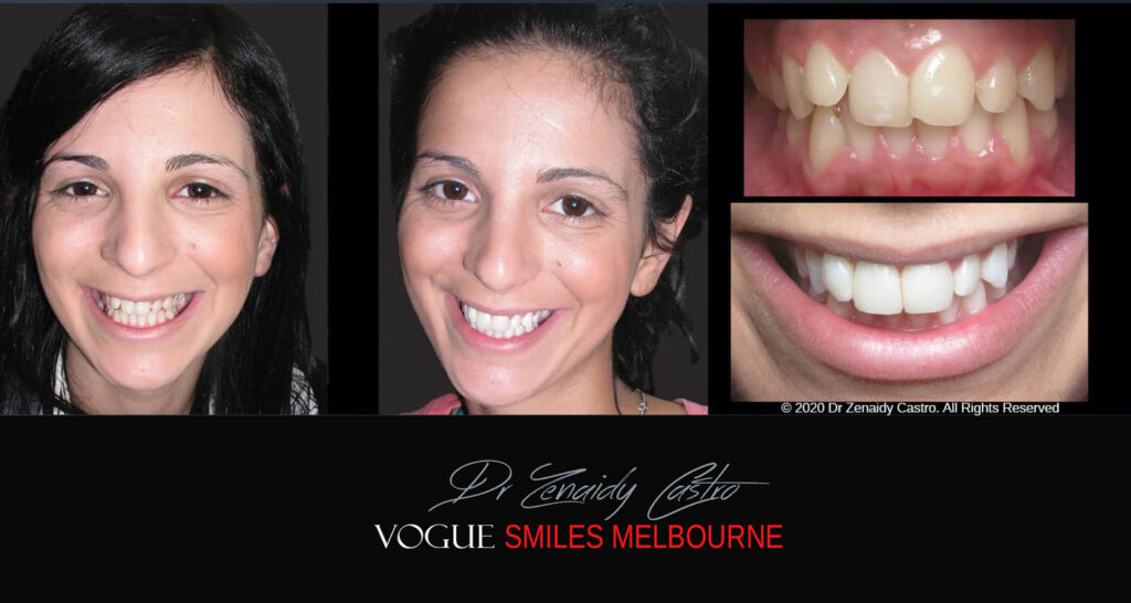 Fix Crooked Teeth - Instant Teeth Straightening with Porcelain Veneers -Family Cosmetic Dental Practice - Noble Park North Dentist