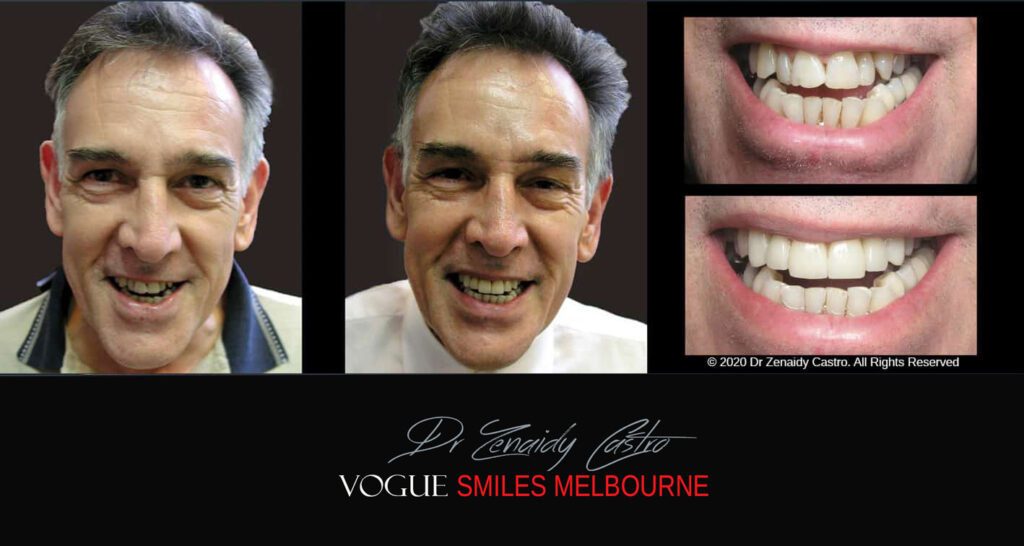 Fix Crooked Teeth - Instant Teeth Straightening with Porcelain Veneers -Family Cosmetic Dental Practice - Noble Park North Dentist