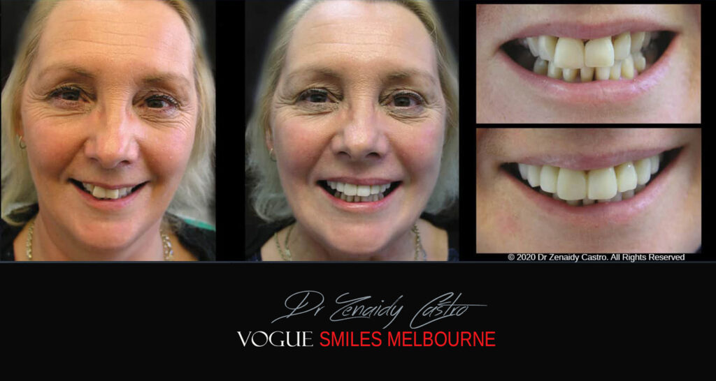 Fix Crooked Teeth - Instant Teeth Straightening with Porcelain Veneers -Family Cosmetic Dental Practice - Noble Park North Dentist