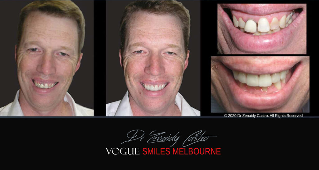 Fix Crooked Teeth - Instant Teeth Straightening with Porcelain Veneers -Family Cosmetic Dental Practice - Noble Park North Dentist