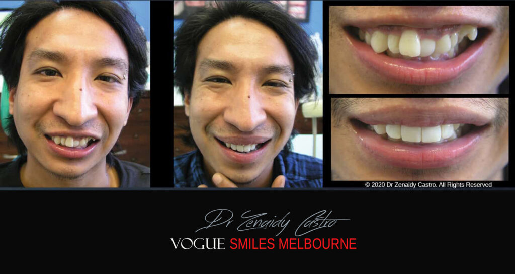 Fix Crooked Teeth - Instant Teeth Straightening with Porcelain Veneers -Family Cosmetic Dental Practice - Noble Park North Dentist