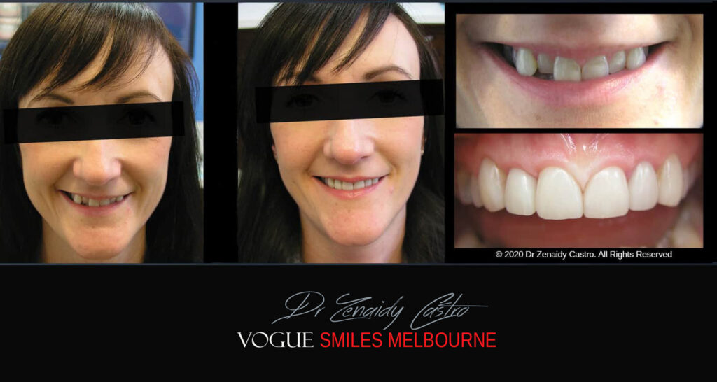 Fix Crooked Teeth - Instant Teeth Straightening with Porcelain Veneers -Family Cosmetic Dental Practice - Noble Park North Dentist