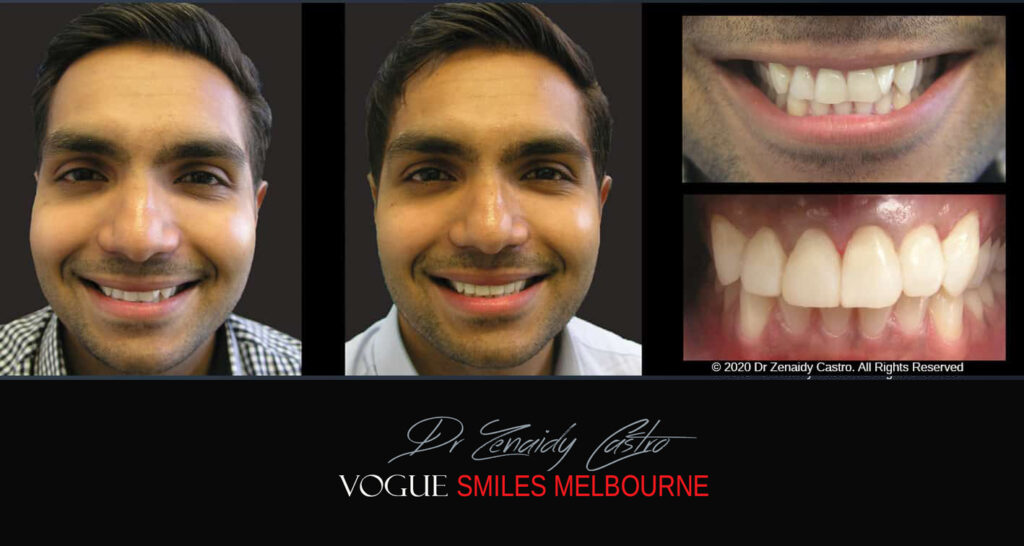 Fix Crooked Teeth - Instant Teeth Straightening with Porcelain Veneers -Family Cosmetic Dental Practice - Noble Park North Dentist