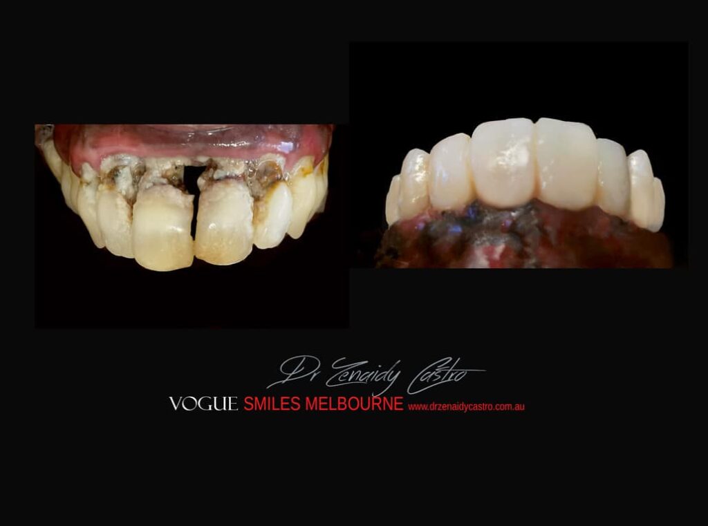 TRANSITIONAL-MAKEOVERS-Cheap-Smile-Makoever-Solutions