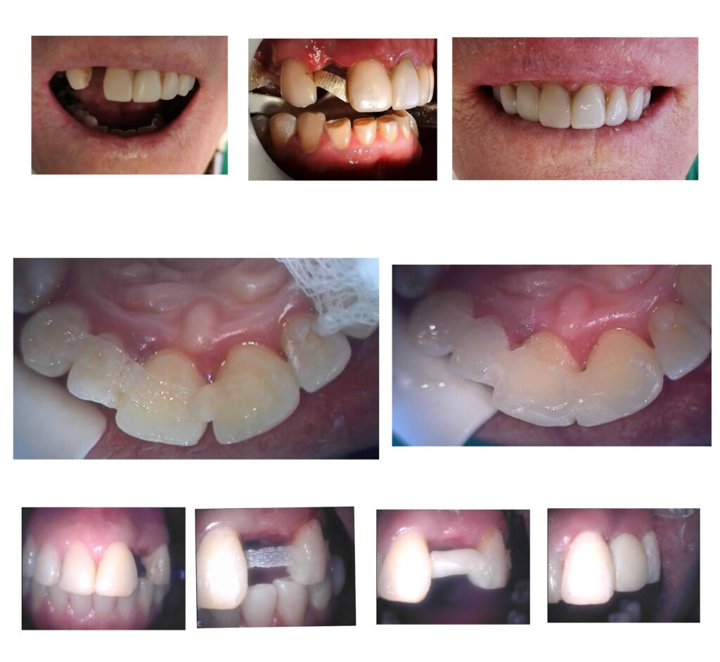 TRANSITIONAL-MAKEOVERS-Cheap-Smile-Makoever-Solutions