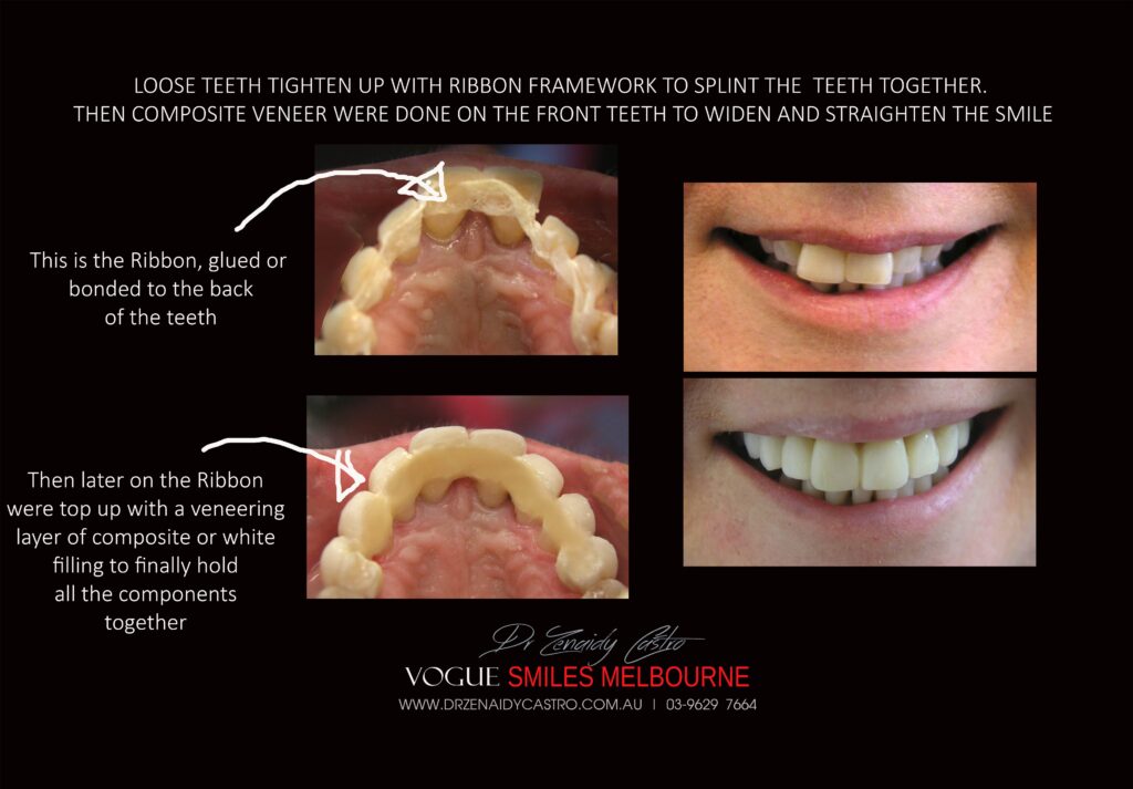 TRANSITIONAL-MAKEOVERS-Cheap-Smile-Makoever-Solutions