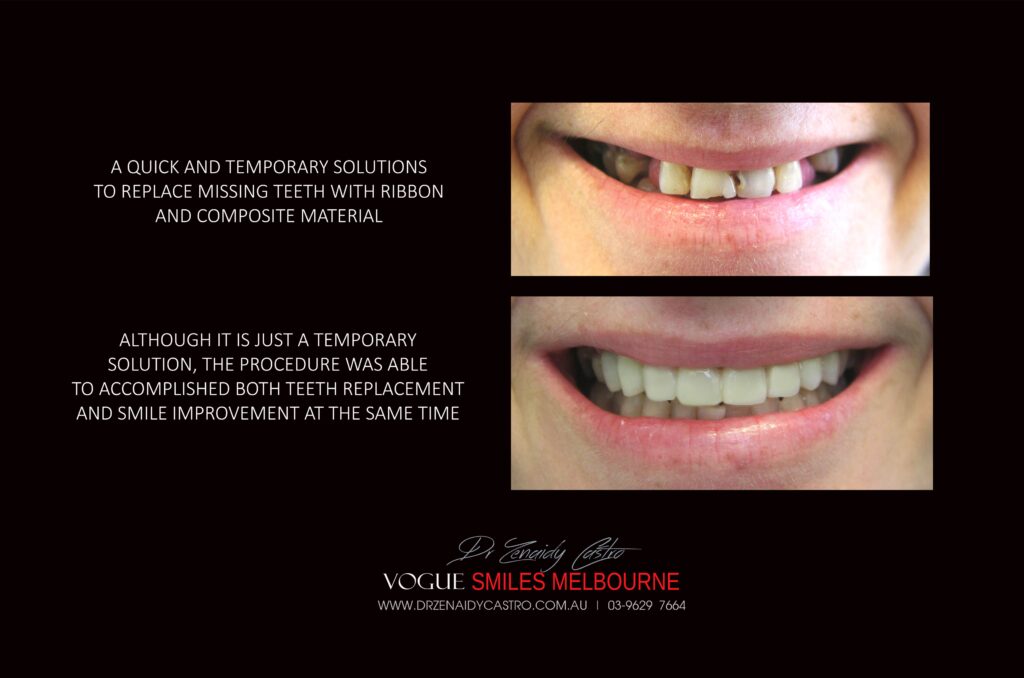 TRANSITIONAL-MAKEOVERS-Cheap-Smile-Makoever-Solutions