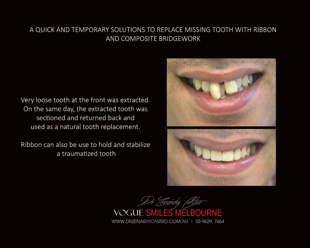 TRANSITIONAL-MAKEOVERS-Cheap-Smile-Makoever-Solutions