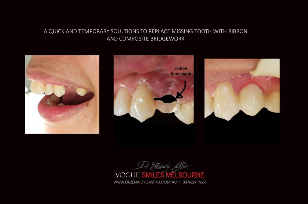 TRANSITIONAL-MAKEOVERS-Cheap-Smile-Makoever-Solutions