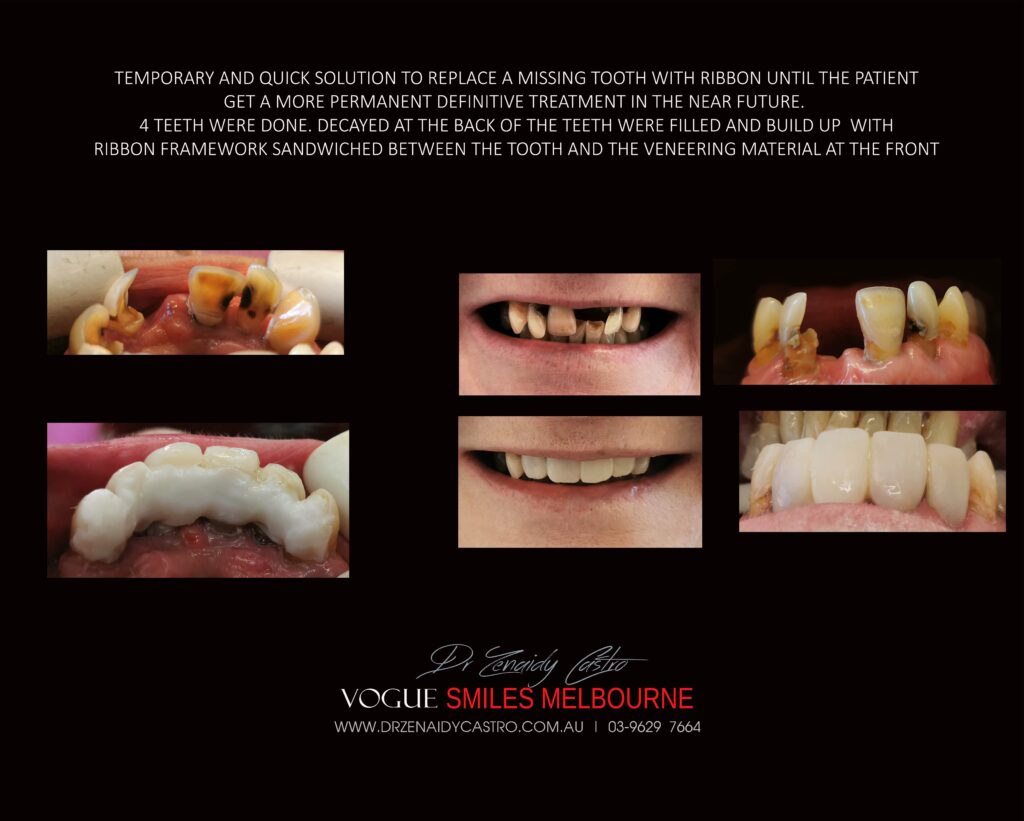 TRANSITIONAL-MAKEOVERS-Cheap-Smile-Makoever-Solutions