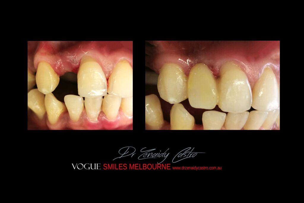 TRANSITIONAL-MAKEOVERS-Cheap-Smile-Makoever-Solutions