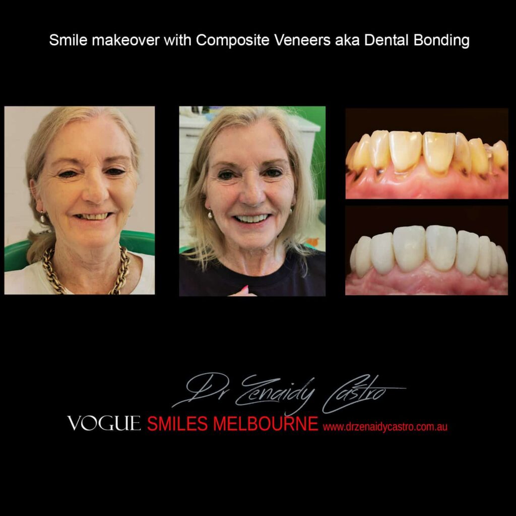 TRANSITIONAL-MAKEOVERS-Cheap-Smile-Makoever-Solutions