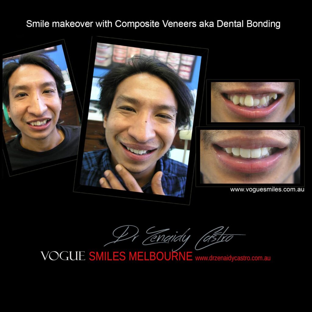 TRANSITIONAL-MAKEOVERS-Cheap-Smile-Makoever-Solutions