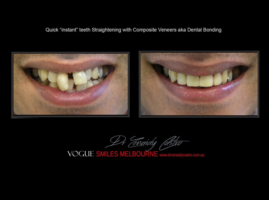 TRANSITIONAL-MAKEOVERS-Cheap-Smile-Makoever-Solutions