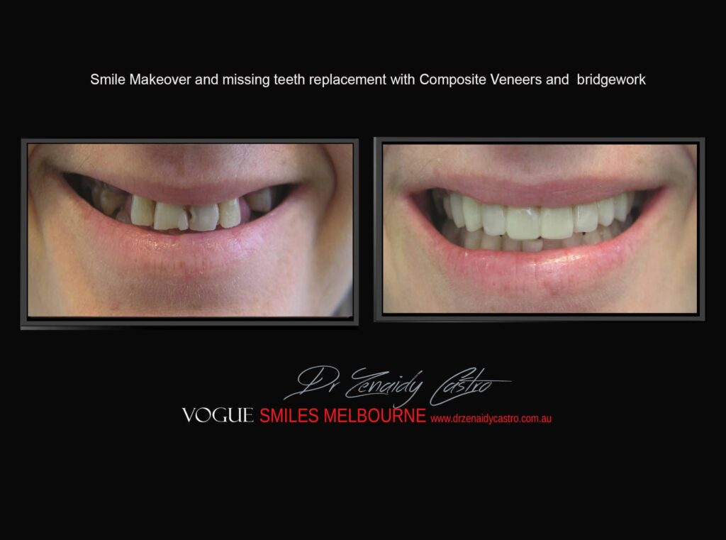 TRANSITIONAL-MAKEOVERS-Cheap-Smile-Makoever-Solutions