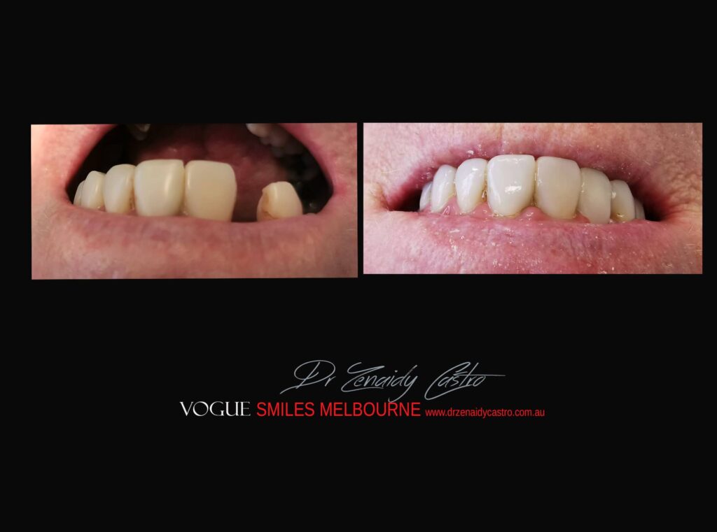 TRANSITIONAL-MAKEOVERS-Cheap-Smile-Makoever-Solutions