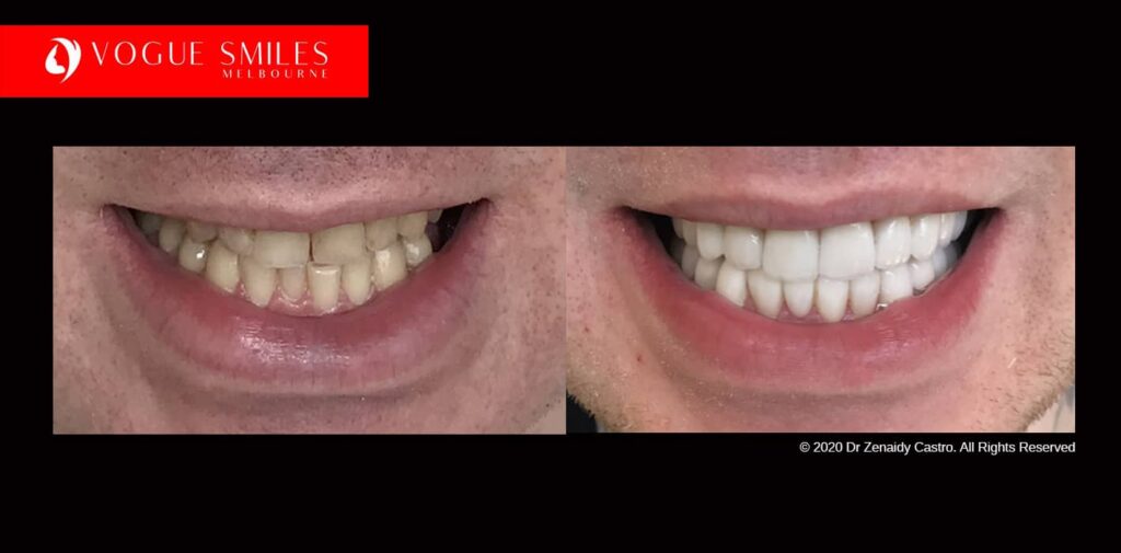 Teeth-Whitening-Before-and-After-Melbourne-CBD-Noble-