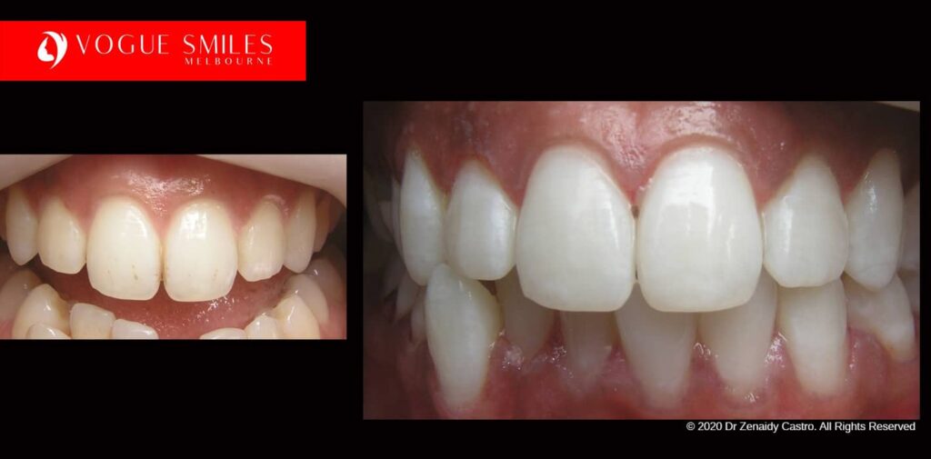 Teeth-Whitening-Before-and-After-Melbourne-CBD-Noble-