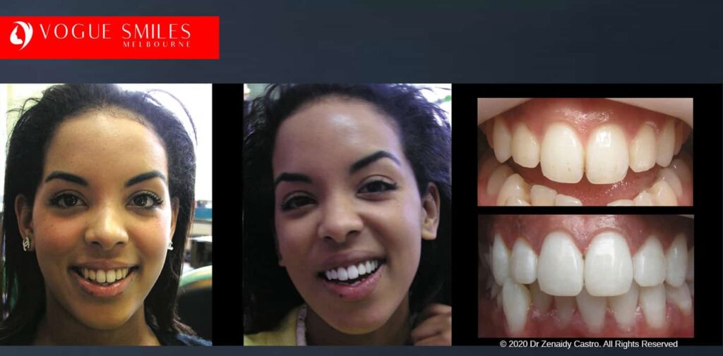 Teeth-Whitening-Before-and-After-Melbourne-CBD-Noble-