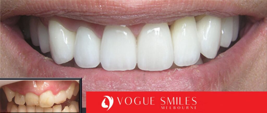 Teeth-Whitening-Before-and-After-Melbourne-CBD-Noble-