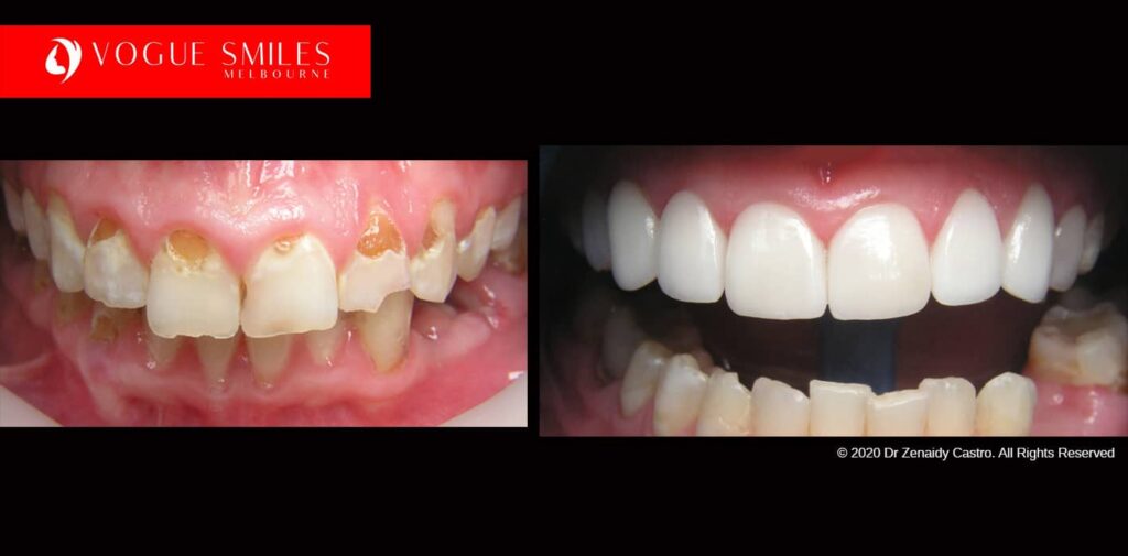 Teeth-Whitening-Before-and-After-Melbourne-CBD-Noble-
