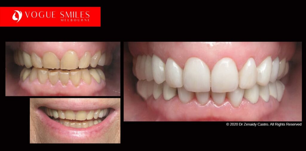 Teeth-Whitening-Before-and-After-Melbourne-CBD-Noble-