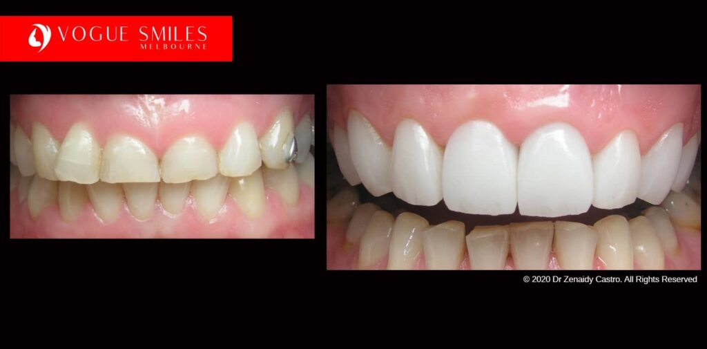 Teeth-Whitening-Before-and-After-Melbourne-CBD-Noble-
