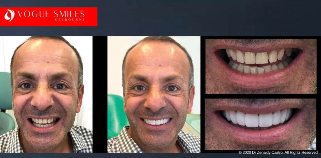 Teeth-Whitening-Before-and-After-Melbourne