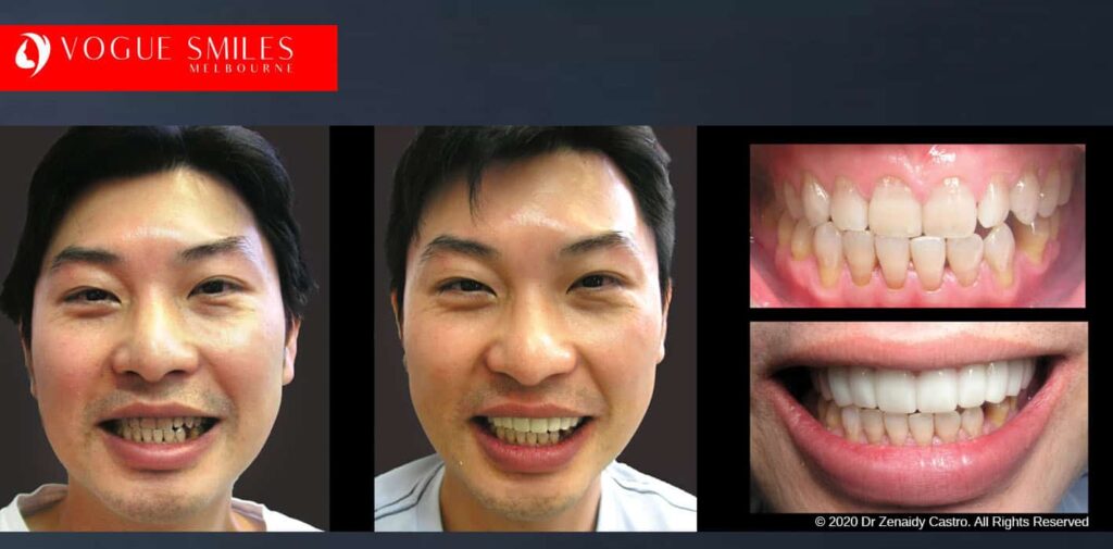Teeth-Whitening-Before-and-After-Melbourne-CBD-Noble-