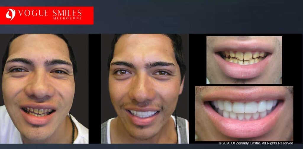Teeth-Whitening-Before-and-After-Melbourne-CBD-Noble-