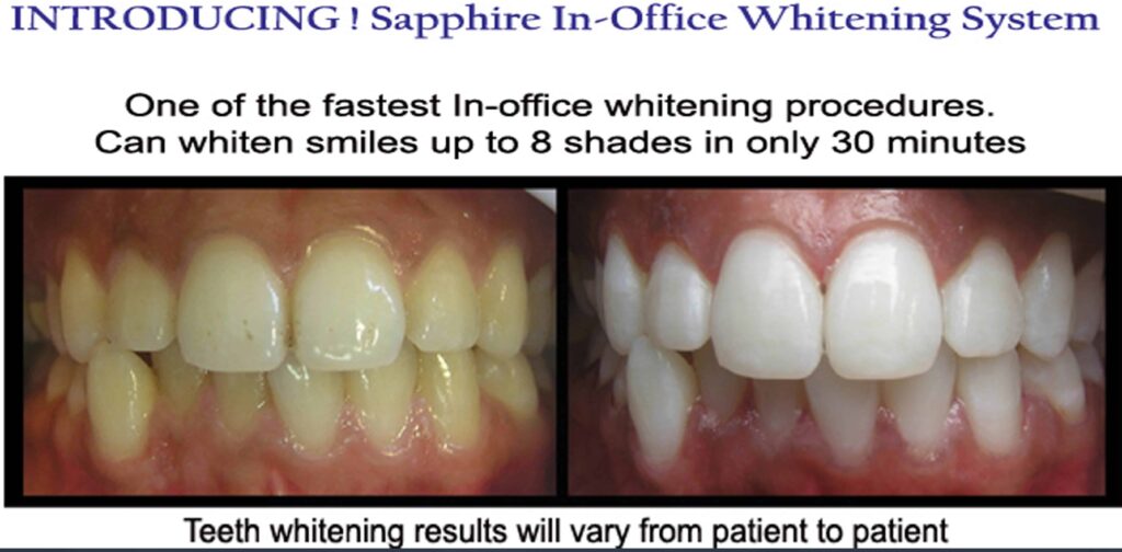 Teeth-Whitening-Before-and-After-Melbourne-CBD-Noble