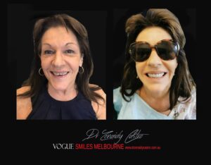 Aftercare Tips for Newly Cemented Porcelain Veneers