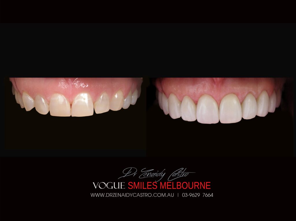 VOGUE-SMILES-COSMETIC-DENTISTRY-TREATMENT