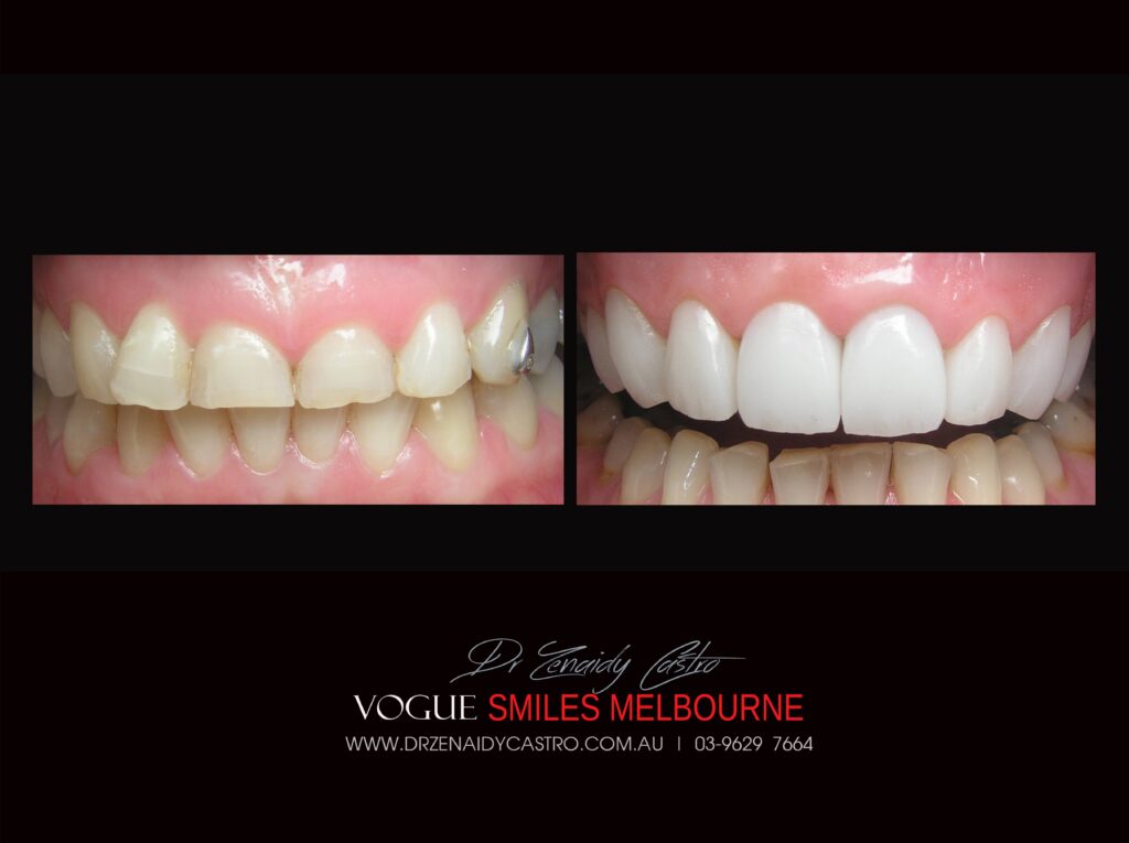 VOGUE-SMILES-COSMETIC-DENTISTRY-TREATMENT