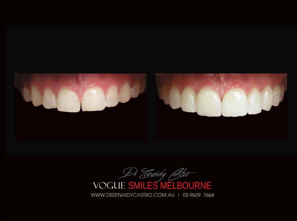 VOGUE-SMILES-COSMETIC-DENTISTRY-TREATMENT