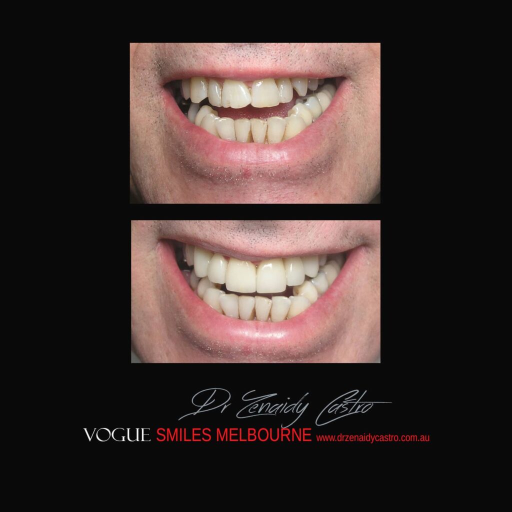 VOGUE-SMILES-COSMETIC-DENTISTRY-TREATMENT-193.j