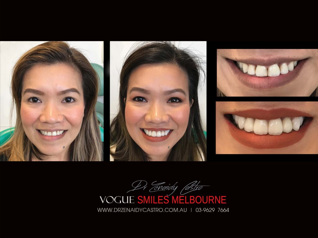 VOGUE-SMILES-COSMETIC-DENTISTRY-TREATMENT