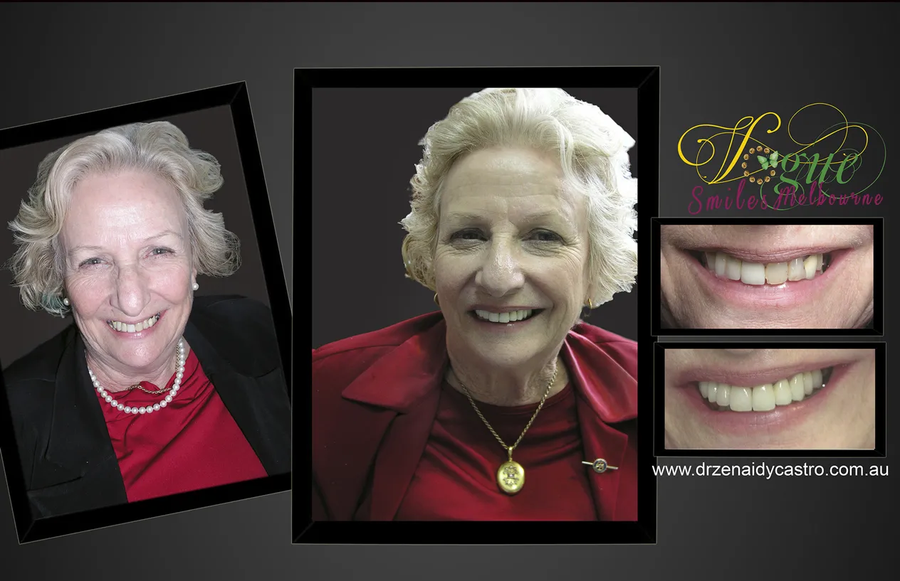 Affordable Alternatives to Dental Implants in Melbourne