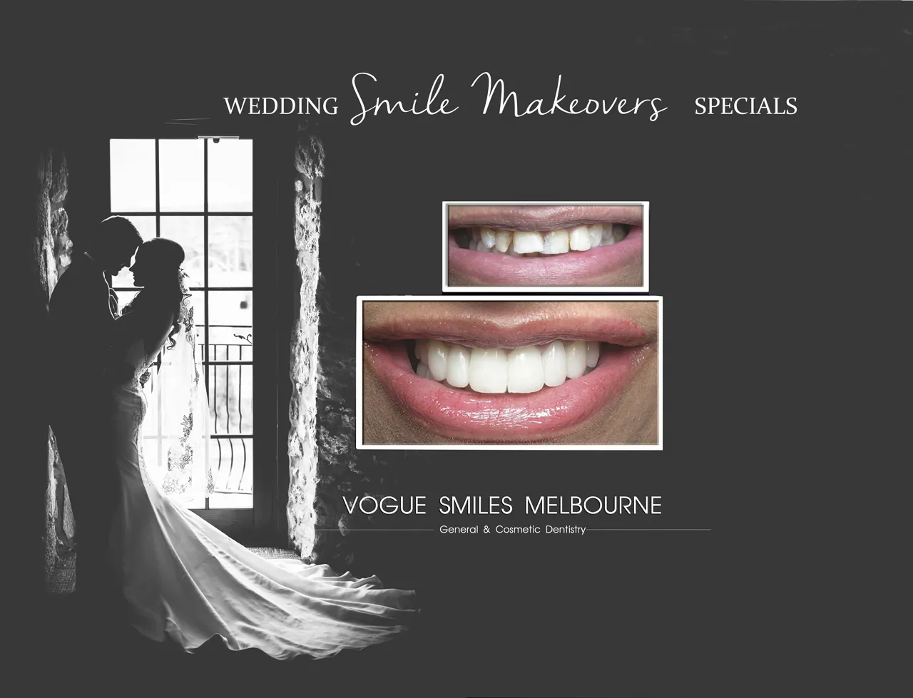  Wedding Day Smile Makeover : Your Cosmetic Dentistry Guide