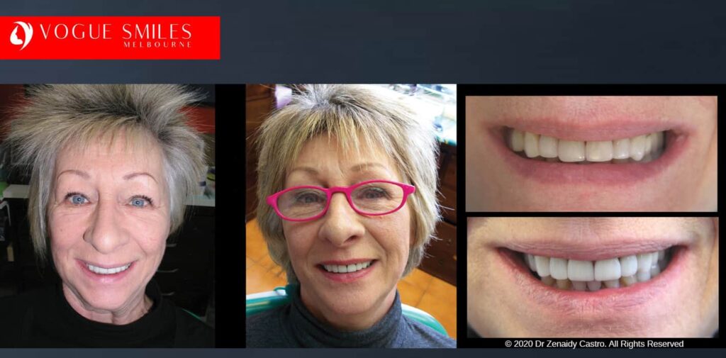 Top Signs Your Dental Crown Is Failing and Needs Replacement, Cheapest Cosmetic Dentist Near Me for Smile Makeovers, Cosmetic Dentistry in Noble Park North, Affordable Smile Makeover Dentistry in Noble Park North. General Dentist Noble Park North- Best Dentist in Noble Park North - Best Dental Clinic in Noble Park North, Best Cosmetic Dentist in Noble Park North. Serving surrounding suburbs Dandenong North, Mulgrave, Springvale, Springvale South, Noble Park, Rowville, Wheelers Hill, Keysborough, and Endeavour Hills, Mulgrave, Glen Waverly