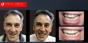 Dental Crown Cost Melbourne: Types, Materials & Prices, Cheapest Cosmetic Dentist Near Me for Smile Makeovers, Cosmetic Dentistry in Noble Park North, Affordable Smile Makeover Dentistry in Noble Park North. General Dentist Noble Park North- Best Dentist in Noble Park North - Best Dental Clinic in Noble Park North, Best Cosmetic Dentist in Noble Park North. Serving surrounding suburbs Dandenong North, Mulgrave, Springvale, Springvale South, Noble Park, Rowville, Wheelers Hill, Keysborough, and Endeavour Hills, Mulgrave, Glen Waverly